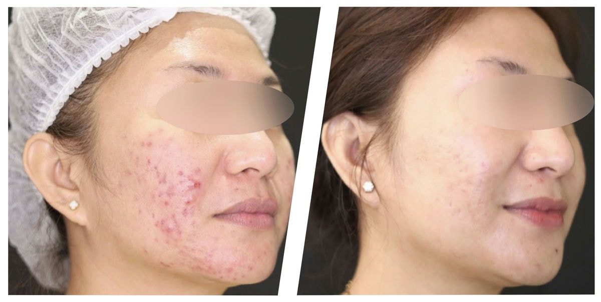 アドバテックスレーザー 症例