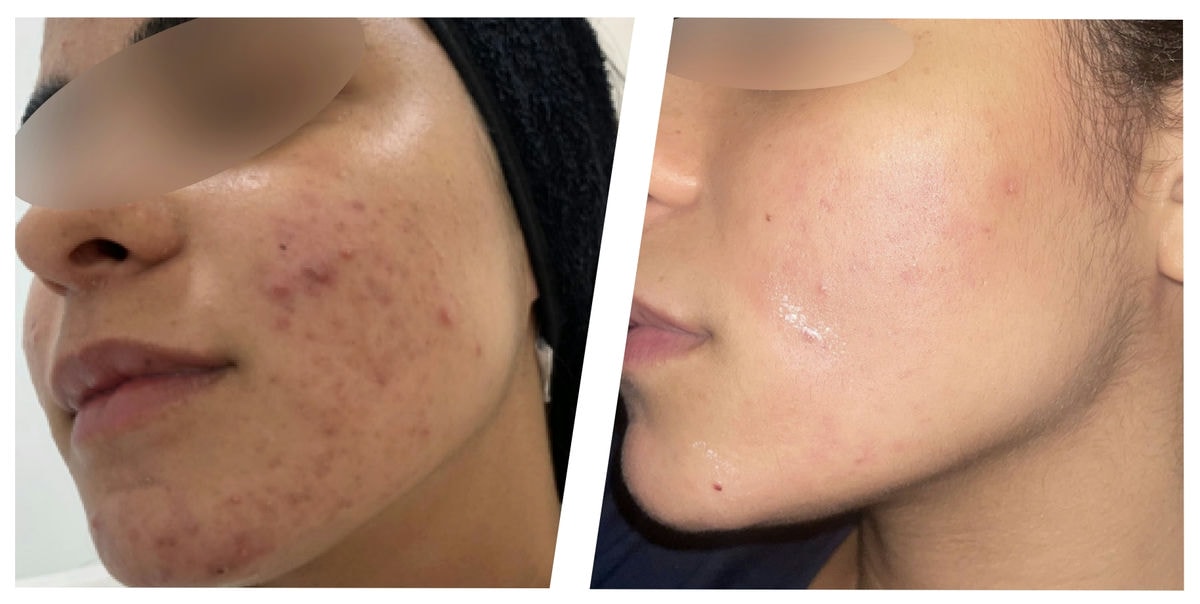 アドバテックスレーザー 症例