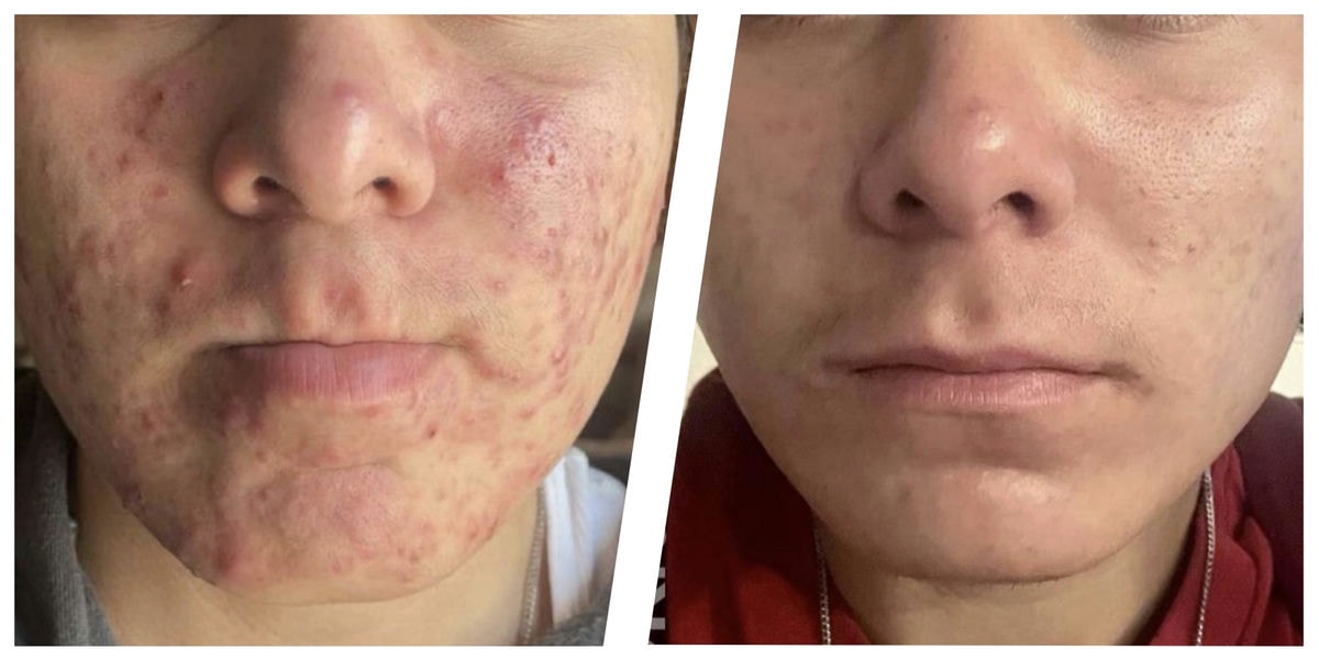 アドバテックスレーザー 症例