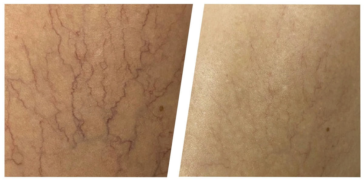 アドバテックスレーザー 症例