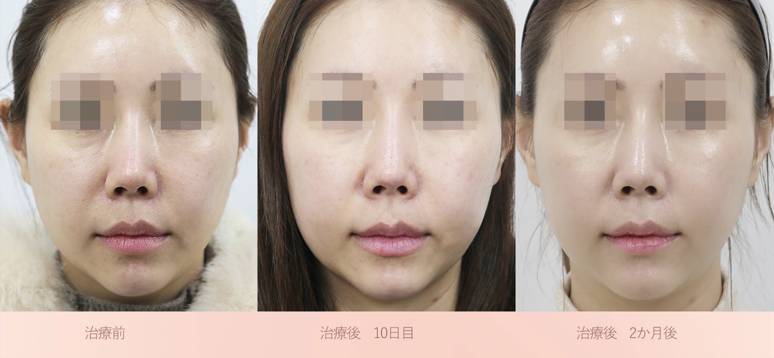 ブナジュ ケース