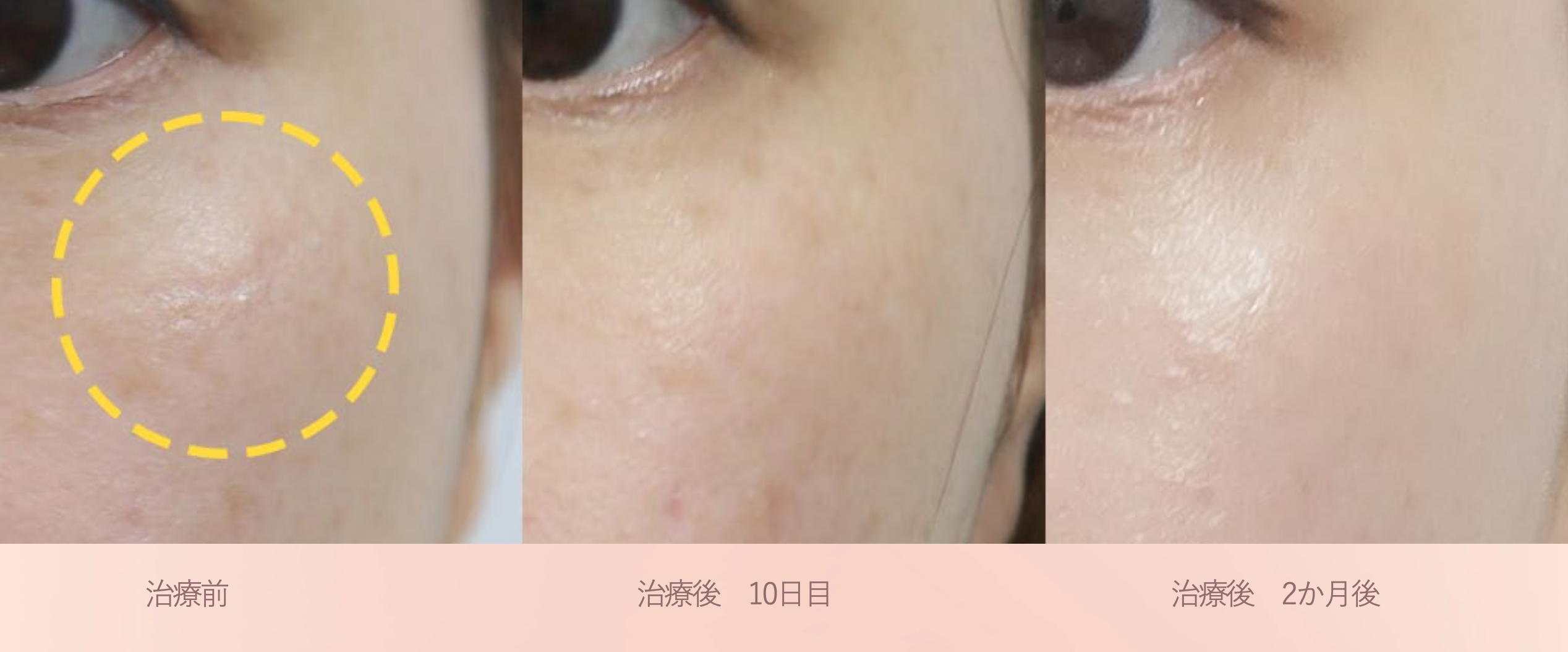 ブナジュ ケース