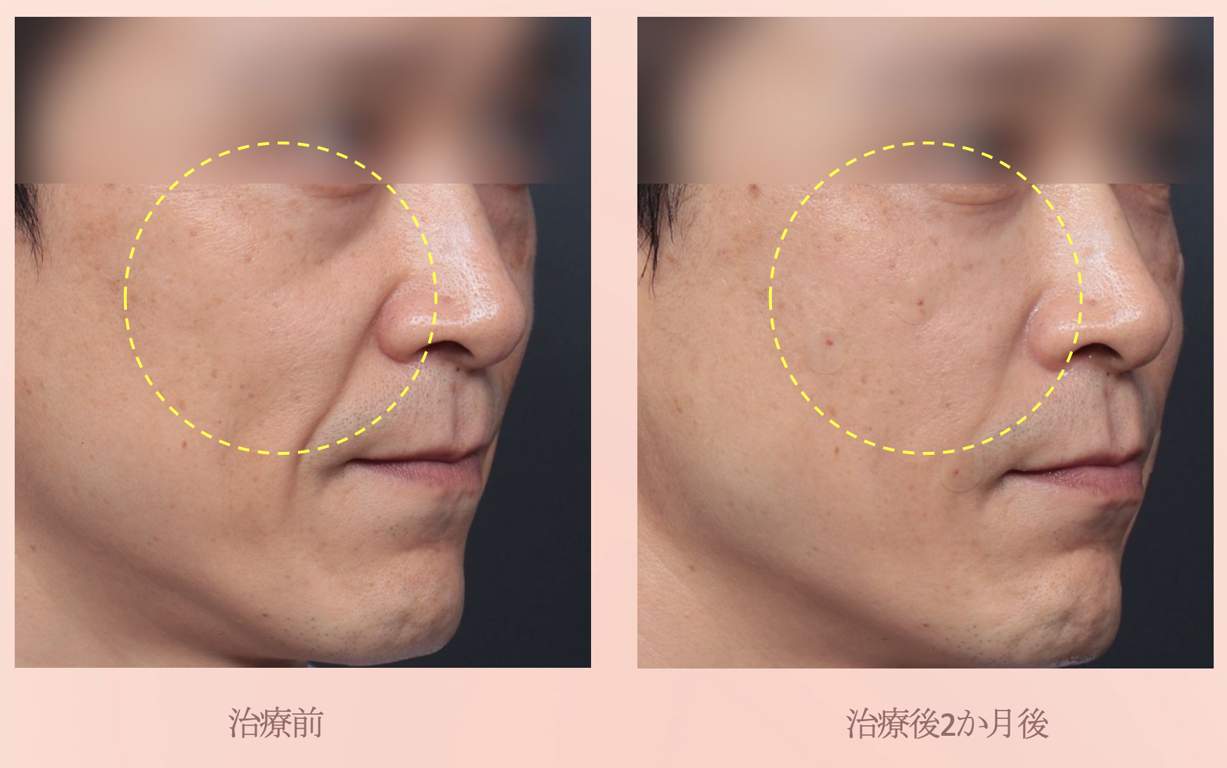 ブナジュ ケース