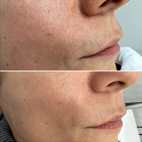 グロウピールの症例