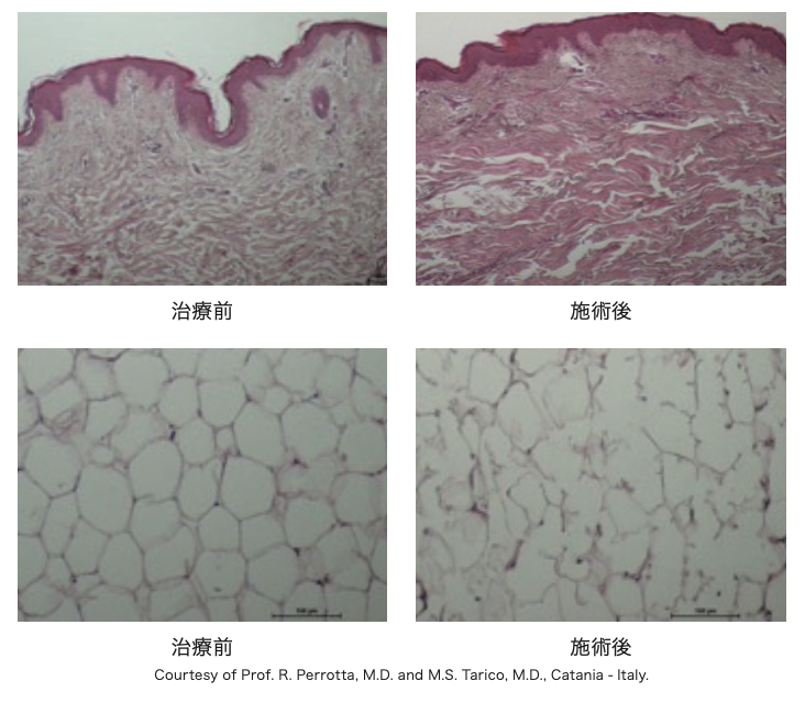 ヒトを対象とした試験において、皮内のコラーゲン増生と脂肪の破壊が確認されています。