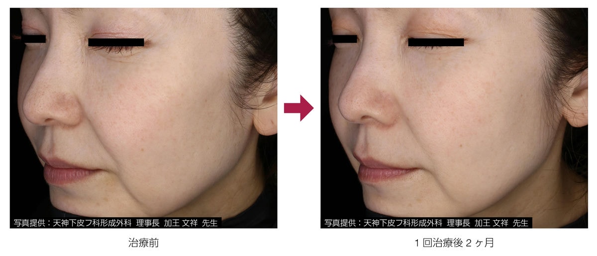 アドバテックスレーザー 症例