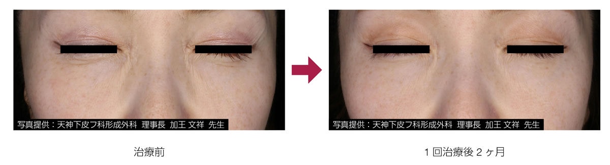 アドバテックスレーザー 症例