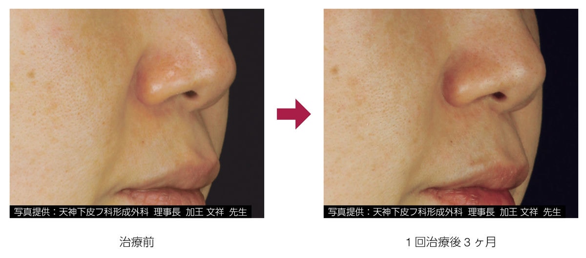 アドバテックスレーザー 症例